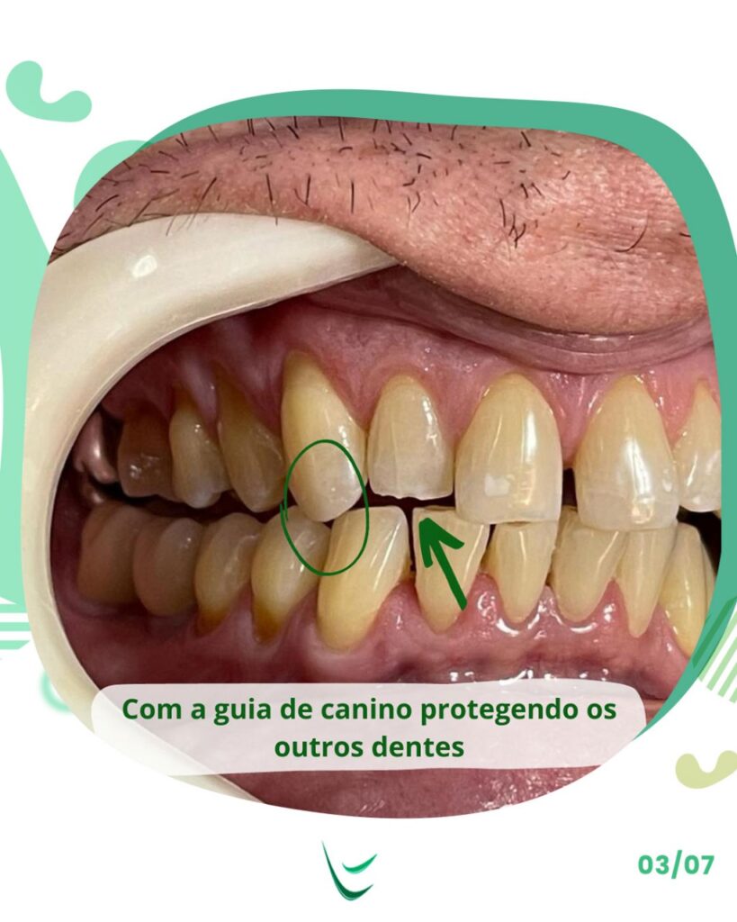 odontocosta-caninos-desalinhados-3